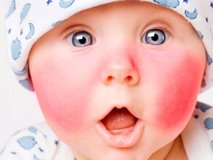 Аллергический диатез